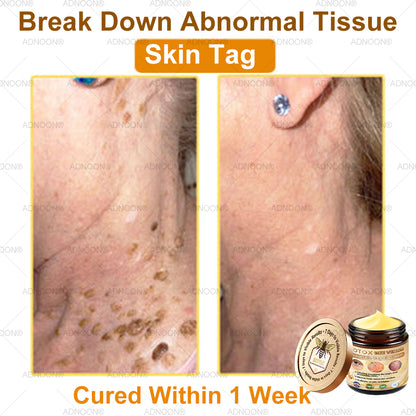 Mayo Clinic Official: ADNOON® Botox Skin Treatment Cream Anti-aging, Hydrating, Skin Repair, Even Tone, Acne and Dark Spot Treatment, Wart and Mole Removal, Psoriasis Relief