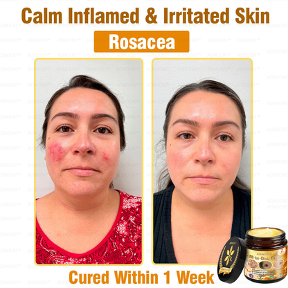 ADNOON™ Bee Venom All-in-One Cream US Dermatologist Approved