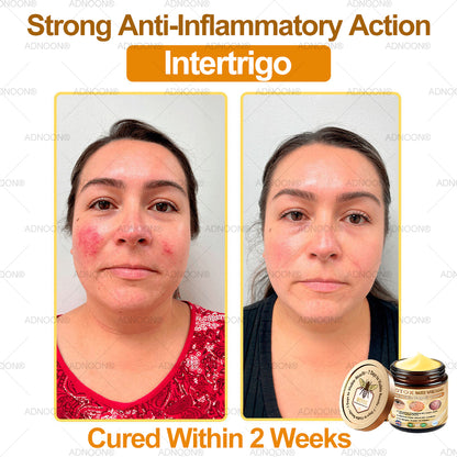 Mayo Clinic Official: ADNOON® Botox Skin Treatment Cream Anti-aging, Hydrating, Skin Repair, Even Tone, Acne and Dark Spot Treatment, Wart and Mole Removal, Psoriasis Relief