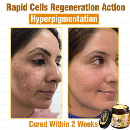 ADNOON™ Bee Venom All-in-One Cream US Dermatologist Approved